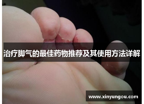 治疗脚气的最佳药物推荐及其使用方法详解