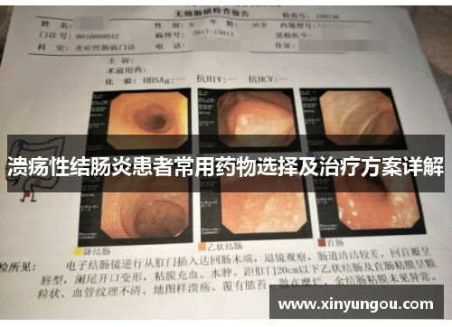 溃疡性结肠炎患者常用药物选择及治疗方案详解